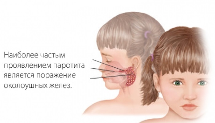 Увеличение околоушных желез Увеличение околоушных желез при паротите