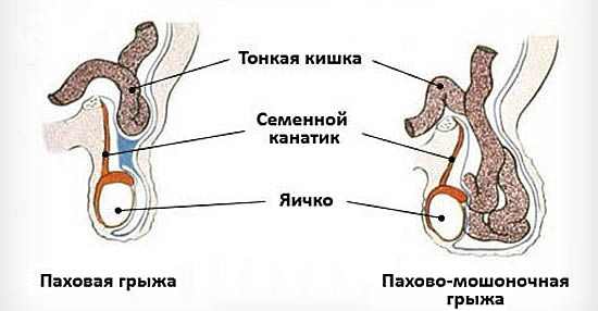 паховая и пахово-машоночная грыжа