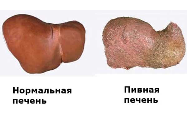 Как влияет пиво на печень человека Печень, пьющего пиво человека