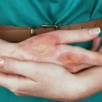 Первая помощь при бытовых термических ожогах кожи Первая помощь при бытовых термических ожогах кожи