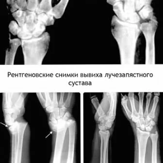 Симптомы растяжения лучезапястного сустава Растяжение запястья: лечение