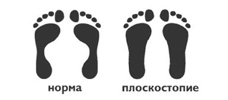 Сравнение плоскостопия и нормальной стопы