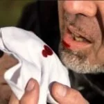 Первая помощь при легочном кровотечении Первая помощь при легочном кровотечении