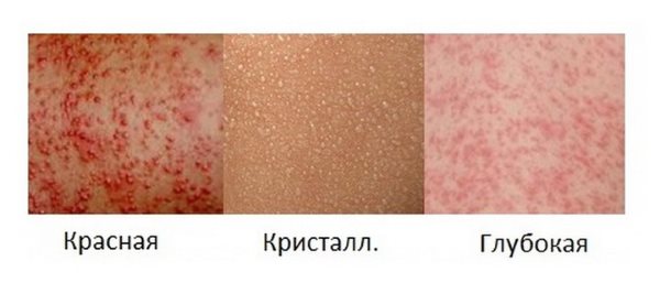 виды потнички