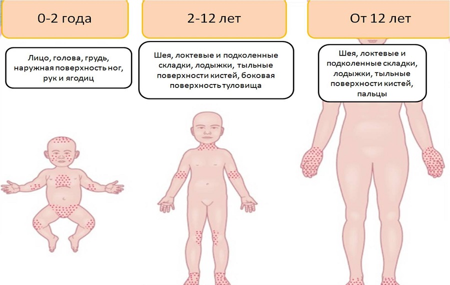 Места образования потницы
