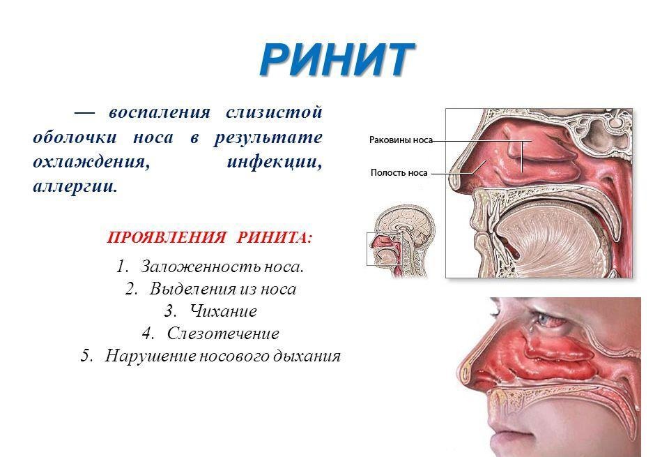 Схема проявлений ринита Проявления ринита