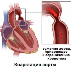 Фото сужения аорты Фото сужения аорты и коарктация