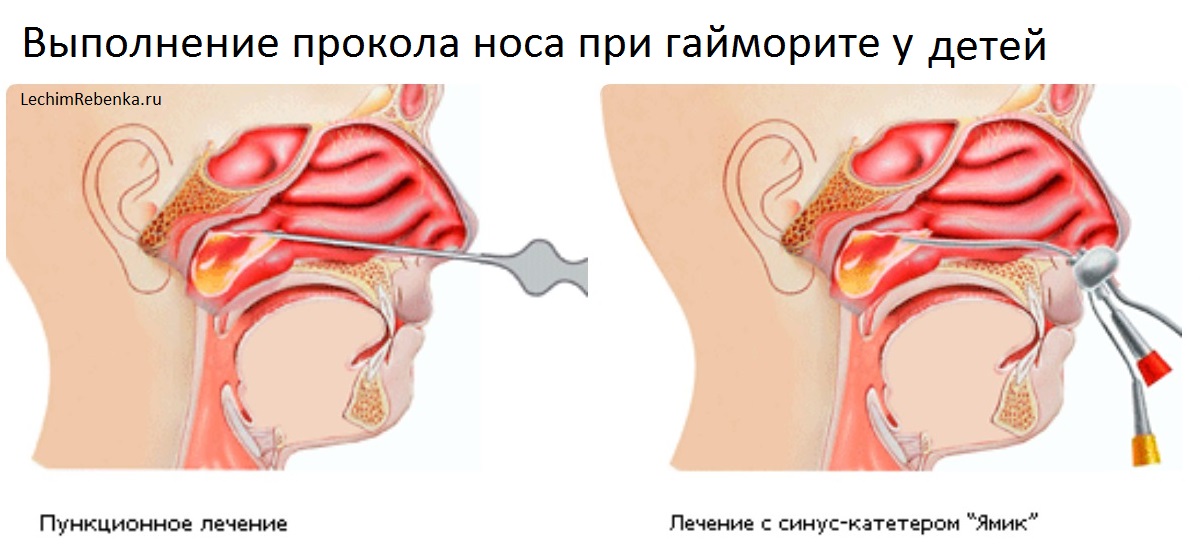 Прокол при гайморите
