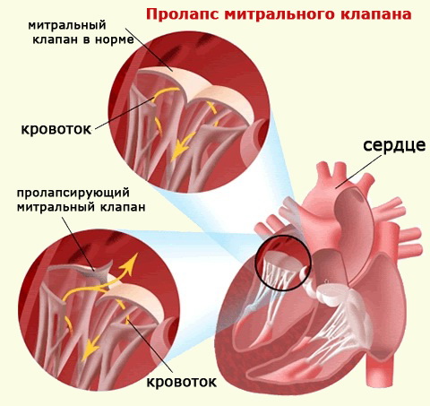 пролапс митрального клапана у детей