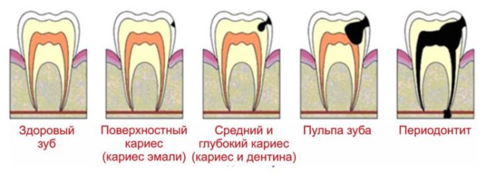 Стадии заболевания зуба
