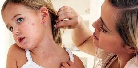 Симптомы кори у детей Симптомы кори у ребенка