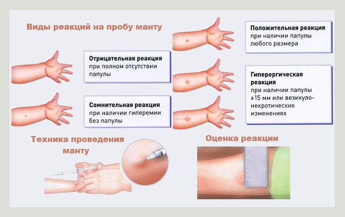 Виды реакций манту Виды реакций манту