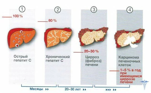 Симптомы, формы и лечение гепатита С