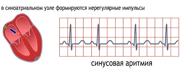 Синусовая аритмия