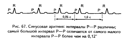 проявление синусовой аритмии