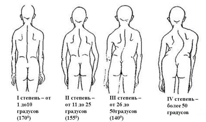 Степени сколиоза Четыре степени сколиоза