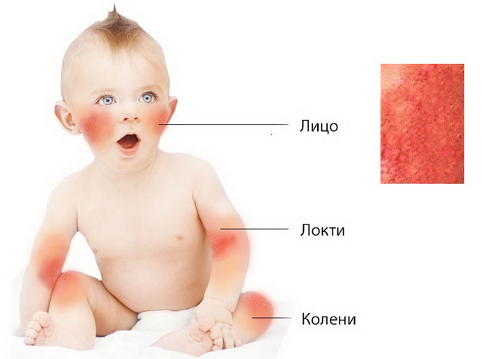 Экзема у грудничка Схема мест появления экземы