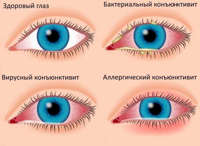 Конъюнктивит Виды конъюнктивита