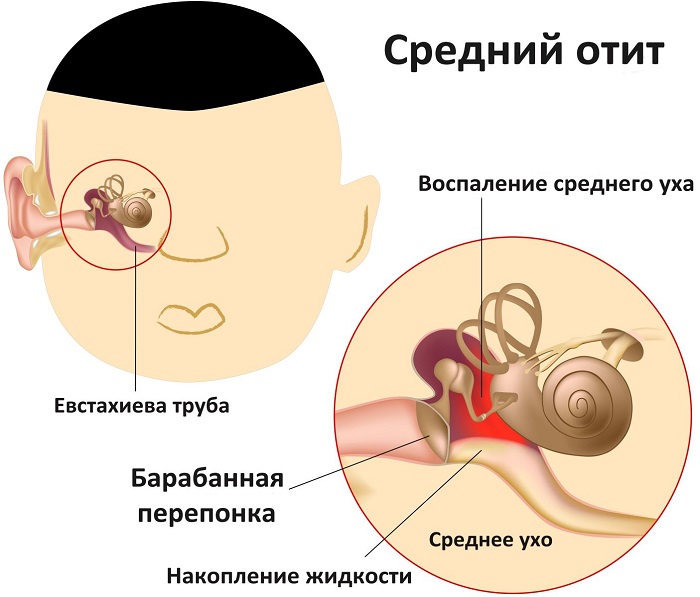 Средний отит на рисунке Отит, схема