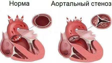Как функционирует аортальный клапан Стеноз устья аорты