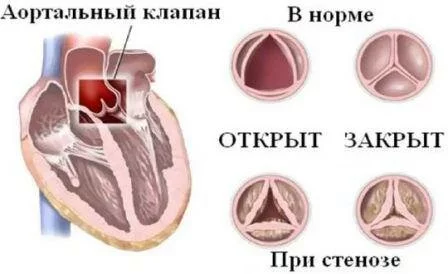 Причины стеноза устья аорты Стеноз устья аорты