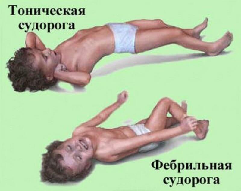 типы судорог