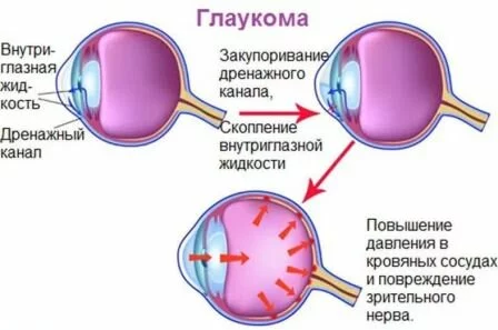 Патологии сосудов Какие таблетки от головной боли