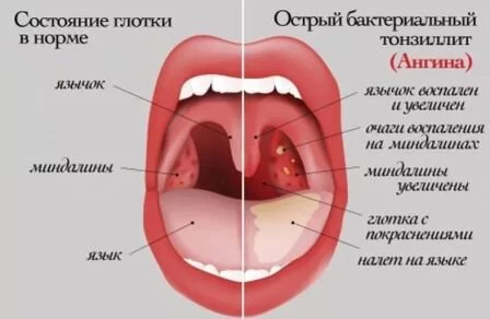 Тонзиллит Таблетки от боли в горле недорогие