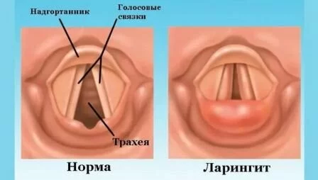 Ларингит Таблетки от боли в горле эффективные
