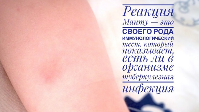 Реакция манту