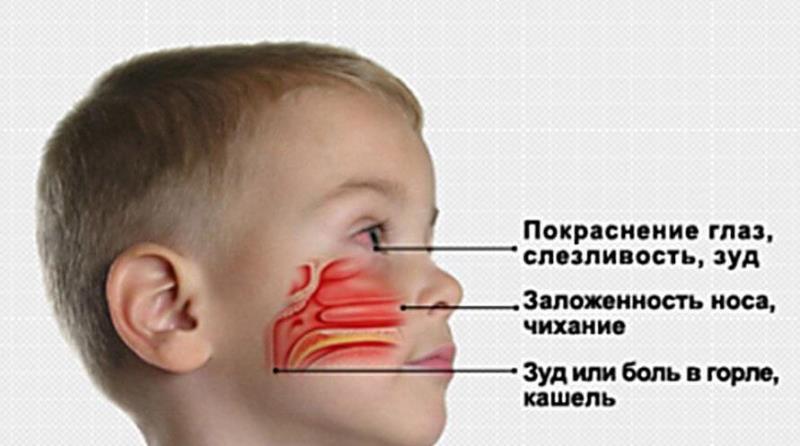 Аллергический ринит