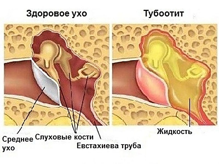 Схема строения здорового уха и с отитом Схема строения здорового уха и с отитом у ребенка