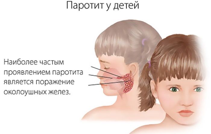 Поражение околоушных желез Паротит у ребенка