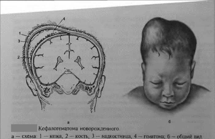 Схема кефалогематомы Кефалогематома новорожденного