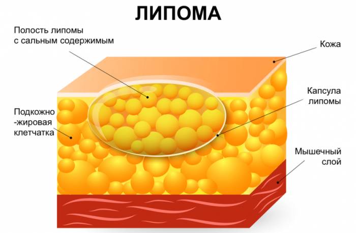 Липома Строение липомы