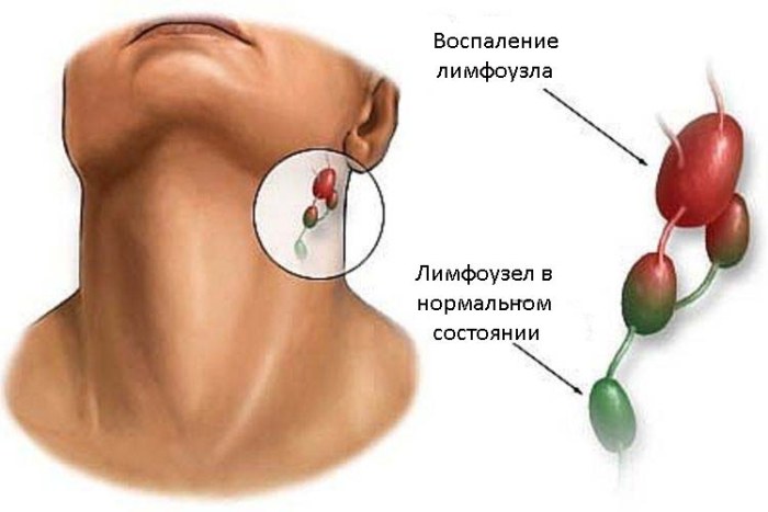 Воспаление лимфоузла Воспаление лимфоузла и лимфоузел в нормальном состоянии