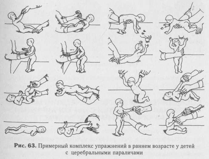 ЛФК и упражнения при дцп