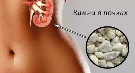 Песок в почках у женщин: симптомы и признаки Песок в почках у женщин: лечение