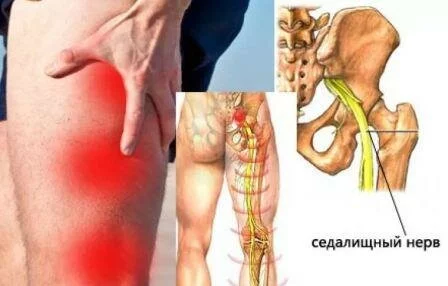 Симптомы защемления нерва Защемление нерва в пояснице боль